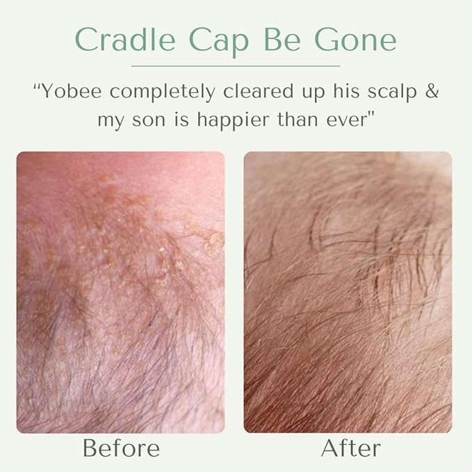 Yobee Ultra Gentle Soothing Scalp Mask - Dry Scalp Treatment Hair Mask Safe For Sensitive Baby Skin - Probiotic Infused - For Sensitive Scalp & Cradle Cap - For Babies, 4 fl oz